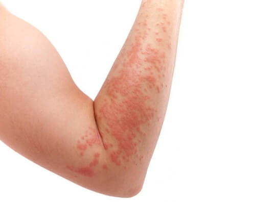 Typy dermatitídy – atopická dermatitída